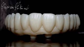 Zirconia Monolithic Implant Bridge [upl. by Holbrooke474]