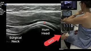 Ultrasound Shoulder  tips for successful rotator cuff and inferior glenohumeral ligament imaging [upl. by Nosae]