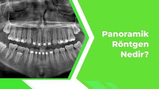 Panoramik Röntgen Nedir [upl. by Thorny]