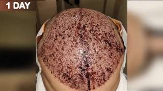 FUE Hair Transplant Timeline I Day 1 to Day 365 [upl. by Wolfgang540]