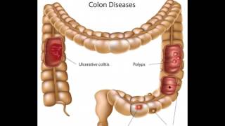 What is Bifidobacterium Infantis [upl. by Leahcimnaj]