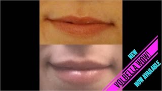 Juvederm Volbella Lip Filler Injection  Dr Rostami  Northern Virginia Washington DC Maryland [upl. by Naugal]