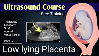 Definition of Low lying Placenta by Dr Ali Waqar [upl. by Ryle]