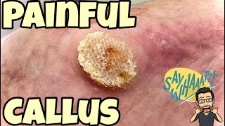 SATISFYING CALLUS REMOVAL FROM FEET [upl. by Lunette408]