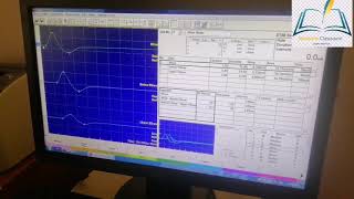 Nerve conduction study of GBSDr Bhupendra Shahmedicine classroom [upl. by Gussie]