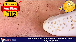 Removal Blackheads under skin clients Very Much  Acne Treatment 112 [upl. by Mccreery]