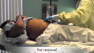 MyShape Lipo Testimonial Abdominal Liposuction Liposuction Specialist Large Volume Liposuction [upl. by Suirauqed]