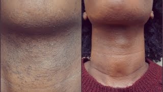 EXCESS FACIAL HAIR  UPDATE amp PRODUCTS I USE [upl. by Dreddy]