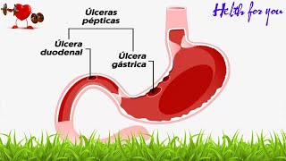 Saúde  Úlcera duodenal o que é sintomas e tratamento [upl. by Demetri]