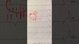 Hyperkalemia  Peaked TWaves  and ECG Recognition [upl. by Christensen]