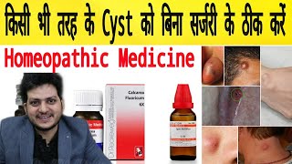 Cyst  Homeopathic Medicine for All type of Cyst  Remove 100 [upl. by Yv]