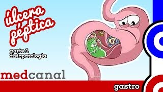 Úlcera Péptica 1  GASTRO [upl. by Auehsoj]