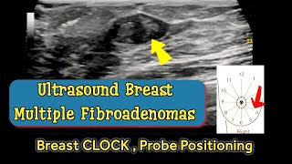 Breast Multiple Fibroadenomas  Positioning according to Breast Clock  Ultrasound [upl. by Ainesy225]