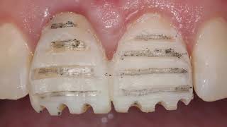 Porcelain Veneer  Preparation through the mock up [upl. by Yht]