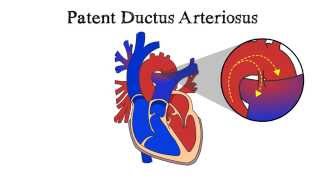 Patent Ductus Arteriosus PDA [upl. by Burt62]