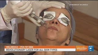 The ULTRACLEAR Laser rejuvenates all skin types [upl. by Gasser]