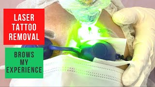 Laser Tattoo Removal Eyebrows My experience full treatment healing process [upl. by Glad871]