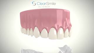 ClearSmile Aligner [upl. by Enram]