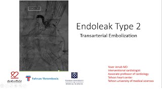 Treatment for Type 2 Endoleak Interventional Radiology Embolisation [upl. by Trub]