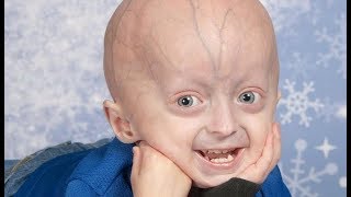 Progeria documentary  kaylee halko Adalia rose Sam berns Hayley okines [upl. by Ayouqat882]