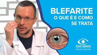 BLEFARITE A inflamação das pálpebras  Dr Diego Denardi  2020 [upl. by Kawasaki]