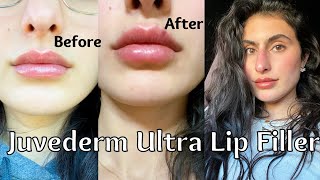 JUVEDERM ULTRA LIP FILLER 1 SYRINGE my experience  healing process [upl. by Eniamaj631]