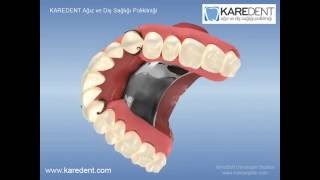Protez Diş Fiyatları Ve Genel Bilgi [upl. by Wylde]