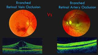 Branch Retinal Vein Occlusion BRVO  FUNDUS and OCT Findings [upl. by Schober661]