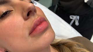 GET THOSE JUICY RUSSIAN LIPS 👄WITH NO DOWNTIME FILLER INJECTIONS  Hollywood CA  Dr Jason Emer [upl. by Neetsirhc918]