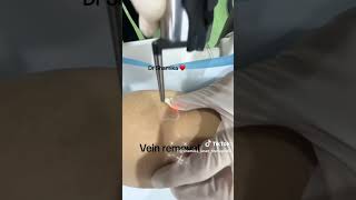 ✅vein removal ازالة الاوردة العنكبوتية Drshamika [upl. by Cy]