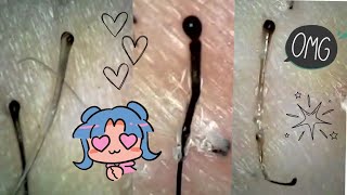 Trich Hair Pulling  LOTS OF BIG JUICY ROOTS PLUCKED SATISFYING MICROSCOPE HAIR PULLS [upl. by Aicala]