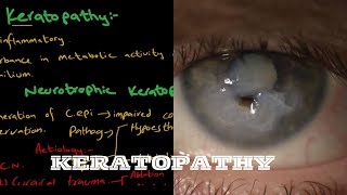 Keratopathy  Neurotrophic Keratopathy  Exposure Keratopathy [upl. by Elpmid]