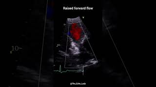 Pulmonary Stenosis 🩵 echocardiogram echocardiography cardiology PulmonaryValve congenital [upl. by Krongold]