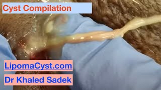 Cyst Pop Compilation Dr Khaled Sadek LipomaCystcom [upl. by Hudnut]