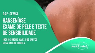 SEMSA  HANSENÍASE  EXAME DE PELE E TESTE DE SENSIBILIDADE [upl. by Elok]