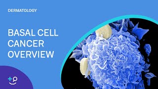 Basal Cell Cancer Overview Dermatology [upl. by Gilcrest49]