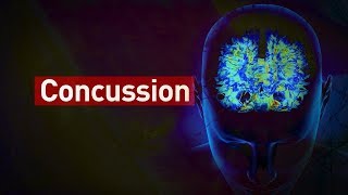 How do concussions affect the brain [upl. by Jordison372]