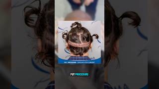 FUE vs FUT scar 4500 grafts FUE process hairtutorial transplant hairtransplant [upl. by Iolande]