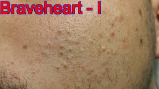 Extraction for Teenage Acne  Part 1 of 3 [upl. by Eiral648]