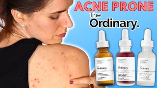 3 Best Acne Products From The Ordinary  For Blemish amp Breakout Prone Skin [upl. by Chao182]