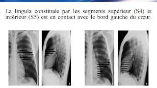 RADIOLOGIE Le signe de la silhouette [upl. by Helbonnah]