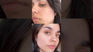 How I Reduced My Pigmentation In 2 weeks😍 [upl. by Grange]