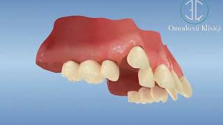 Ortodontik Tedavide Üst Çeneden Diş Eksiltilerek Kanin Dişlerin Yerine Alınması [upl. by Pulchi133]