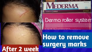 Mederma gel review  How to remove surgery marks  2019 [upl. by Aicelet]