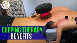 Cupping Therapy Benefits [upl. by Ahtaga]