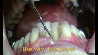 Instructional video on Satelec H3 tip by ACTEON [upl. by Farhsa]