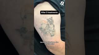 Before amp After Tattoo Removal [upl. by Laurella]