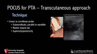 Ultrasound for Peritonsillar Abscess [upl. by Retsevlis]