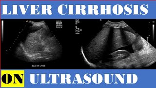 liver Cirrhosis on Ultrasound [upl. by Cosme]