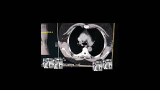 Angiotomografia das Artérias Pulmonares  Protocolo TEP Canon 16 canais [upl. by Turk]